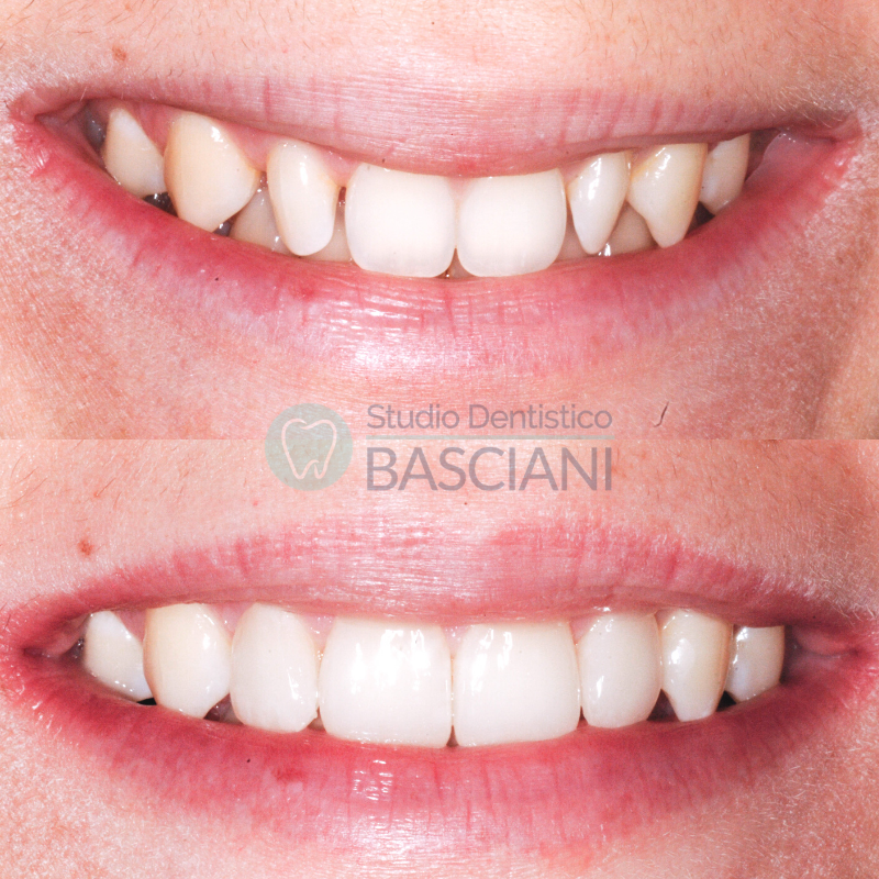 faccette dentali